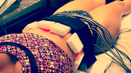 Lipolaser